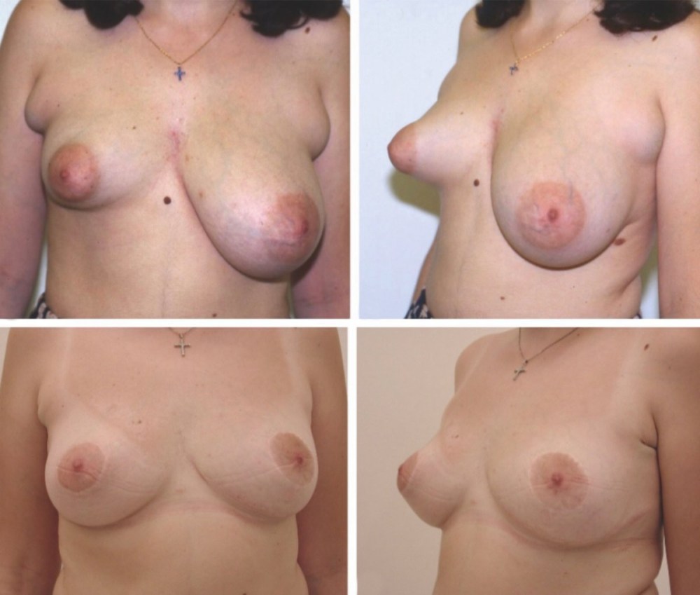 Тубулярная деформация молочных желез