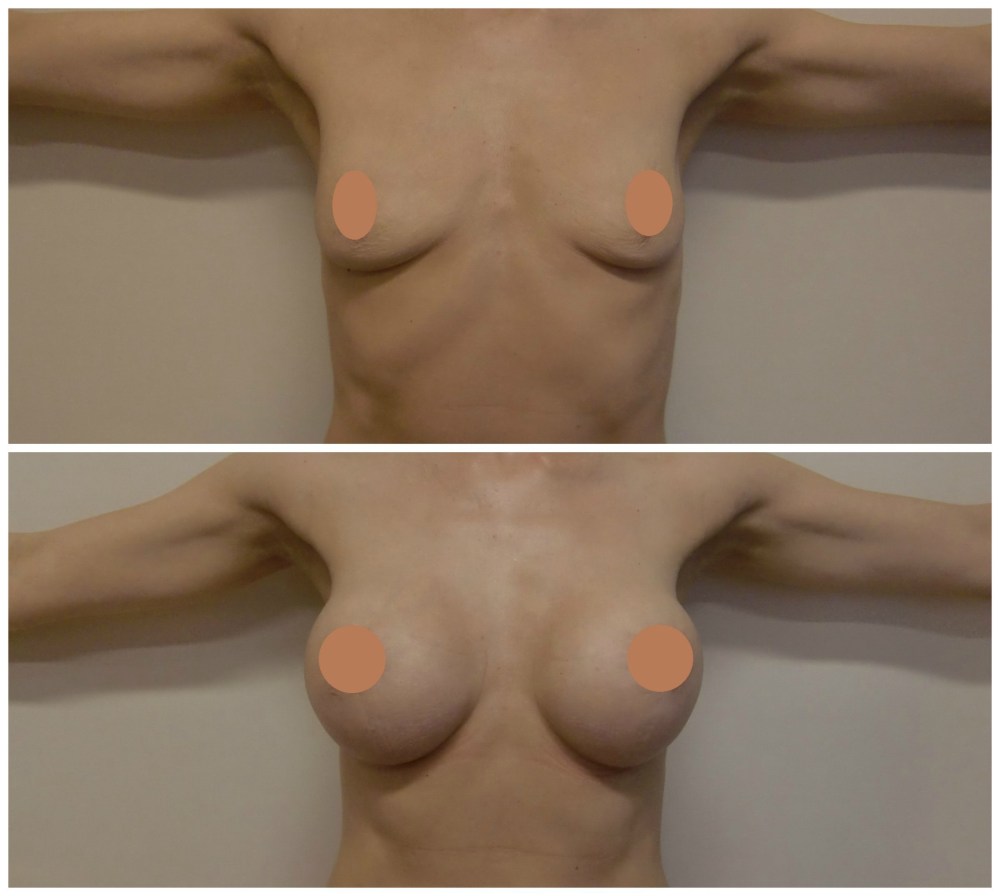 Тубулярная деформация молочных желез