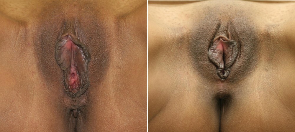 Феминизирующая вагинопластика