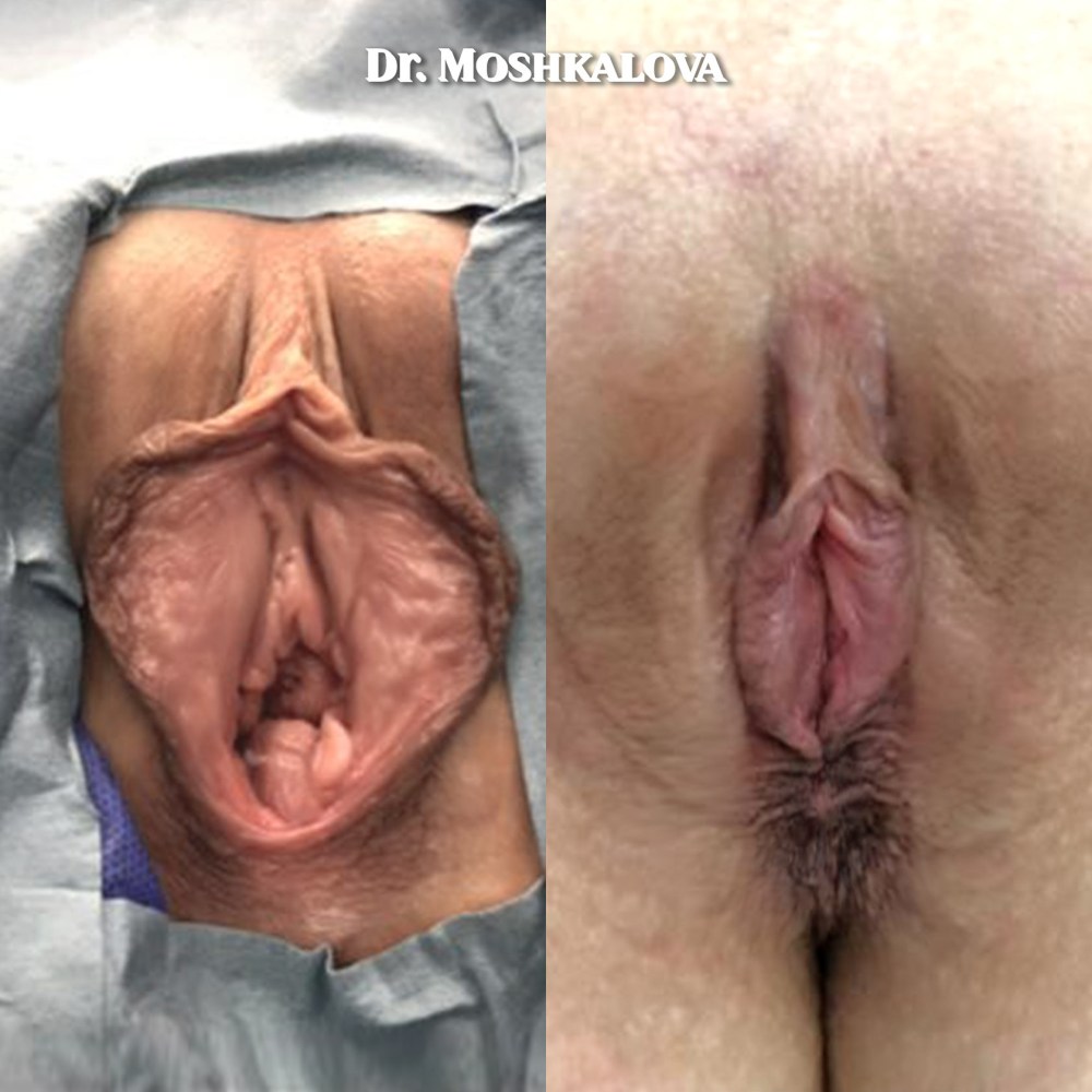 Пластическая операция влагалища до и после