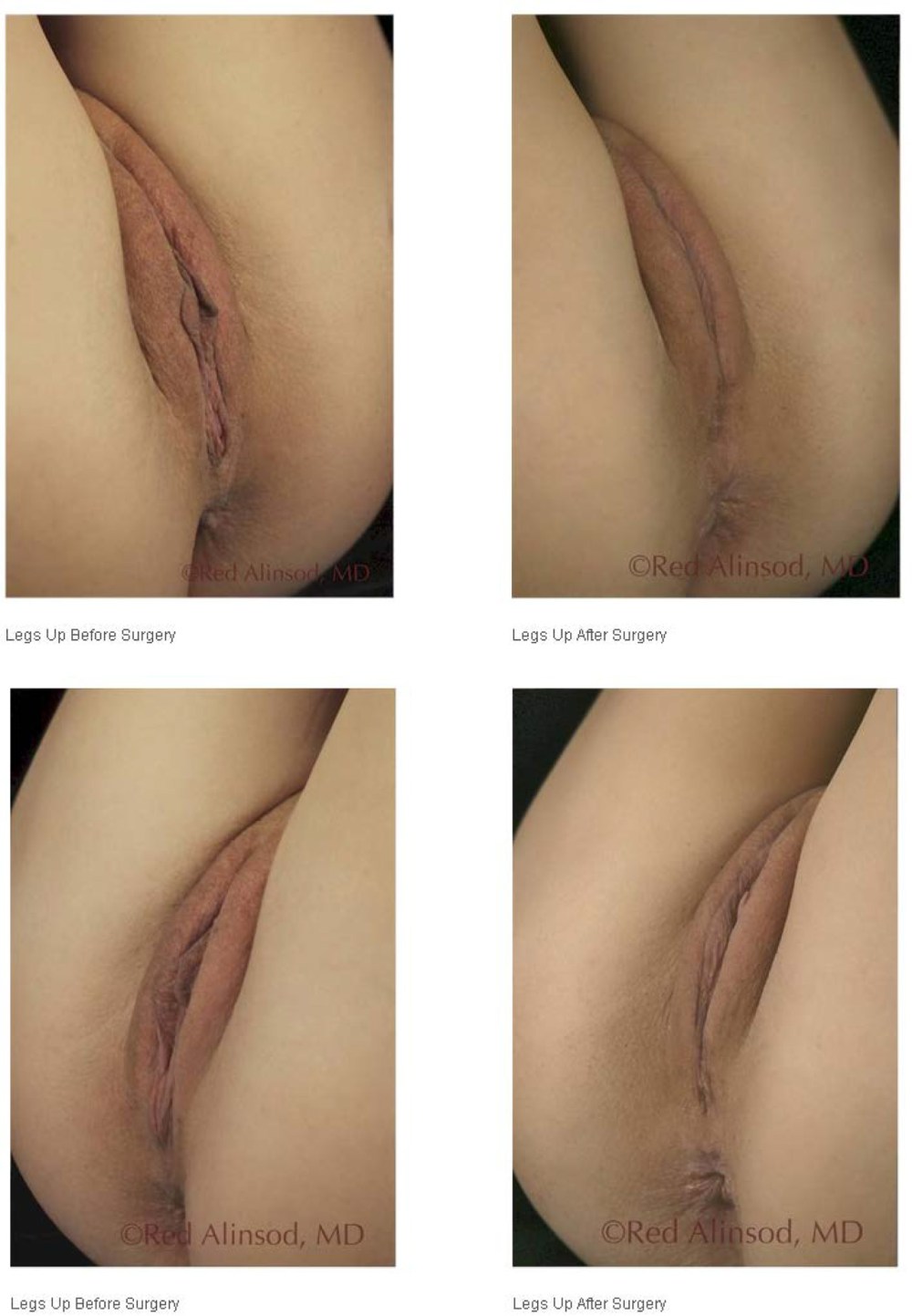 Феминизирующая вагинопластика