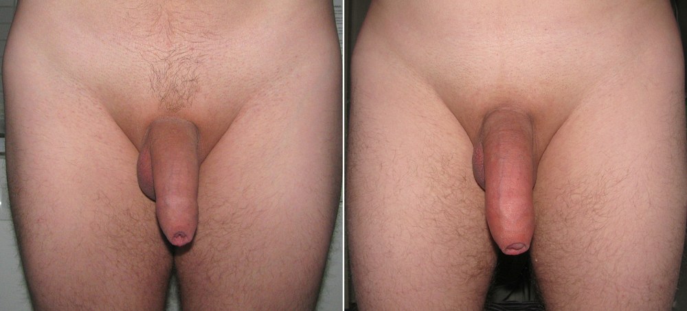 Формы мужских гениталий